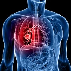 Lungs Cancer Treatment In Hindi